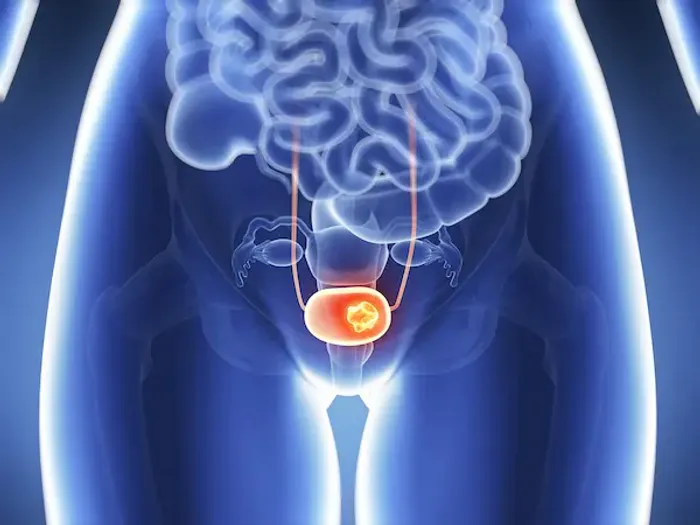 Bladder Cancer